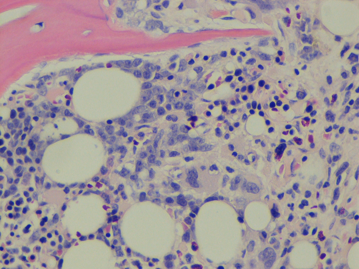 Bone marrow biopsy (H&E): erythroblasts 3